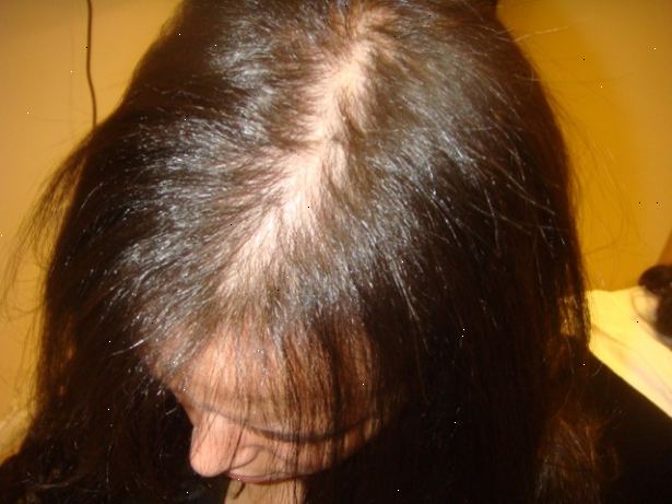 Hoe om te gaan met vrouwelijke kaalheid. Ga online en zoek een bron voor een anti sebolytic scalp cleanser en gebruik het regelmatig.