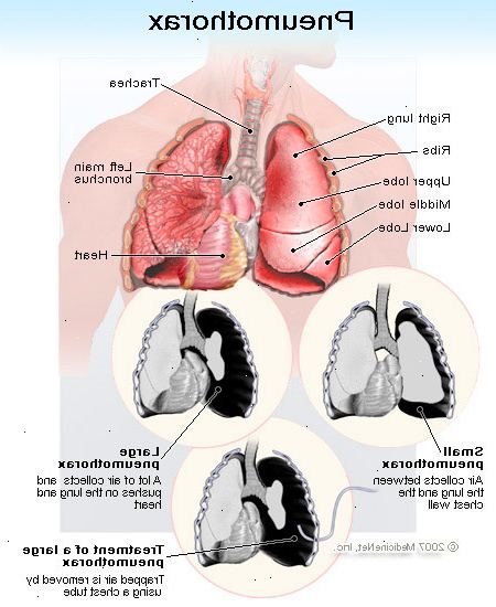 Hoe te genezen van een klaplong. Ga naar de dokter of in noodsituaties onmiddellijk in de kamer als u plotseling pijn op de borst aan 1 kant van je borst in de buurt van de longen.