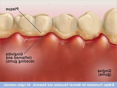 Hoe te voorkomen dat gingivitis. Ga naar je of mondhygiënist om de zes maanden.