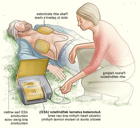 Hoe maak je een defibrillator te gebruiken. Bevestig elektroden op het slachtoffer ontblote borst zoals afgebeeld.