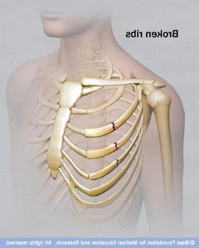 Hoe je gebroken ribben te behandelen. Controleer voor de volgende symptomen om te bepalen of je hebt gebroken ribben.
