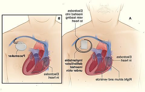 Hoe te leven met een implanteerbare cardioverter defibrillator. Begrijpen hoe een ICD werkt.