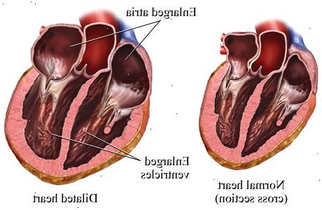 Hoe maak je een vergroot hart te behandelen. Neem angiotensine-converting enzyme (ACE)-remmers, zoals voorgeschreven.