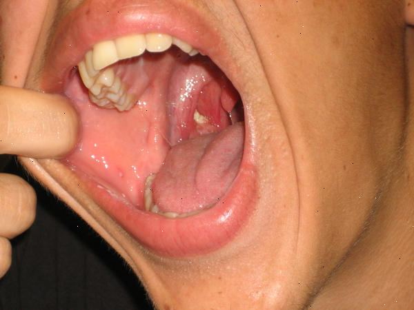 Hoe zich te ontdoen van de tonsillen stenen. Verwijder ze met je vinger.
