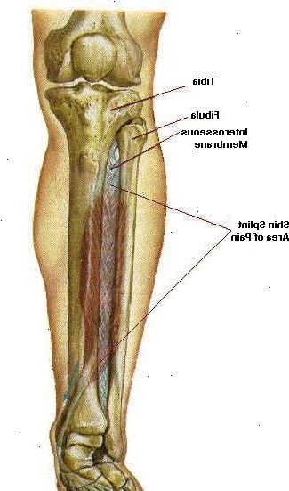 Hoe zich te ontdoen van shin splints. Weet wat de oorzaak van shin splints.