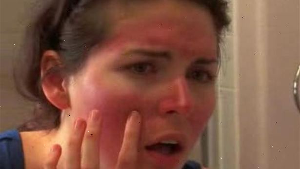 Hoe maak je een zonnebrand te behandelen. Neem een over-the-counter pijnstiller.