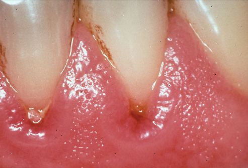 Hoe om te stoppen met bloeden tandvlees, gingivitis, parodontitis. Realiseren dat dit een wond aan uw lichaam - Hetzelfde als een geïnfecteerde snee in je arm.