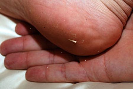 Hoe maak je een splinter te verwijderen met zuiveringszout. Reinig en droog de ​​plek met water en zeep.