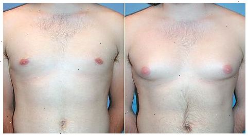 Hoe de mannelijke borsten te verkleinen. Gynaecomastie is een zeldzame hormonale disbalans bij volwassen en adolescente mannen die borstweefsel veroorzaakt te ontwikkelen op een manier die vergelijkbaar is met borstweefsel gevonden bij vrouwen.