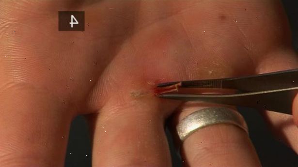 Hoe maak je een splinter te verwijderen. Inspecteer het met een vergrootglas.