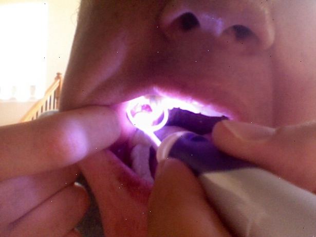 Hoe maak je een droge socket behandeling. Keer terug naar uw kaakchirurg of tandarts.