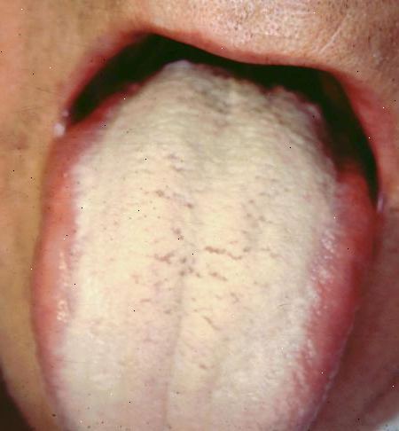 Hoe zich te ontdoen van de witte tong. Te beginnen bij de basis van je tong, plaats de tongreiniger strak tegen het oppervlak van je tong en maak langzame vegen slagen van back-to-front.
