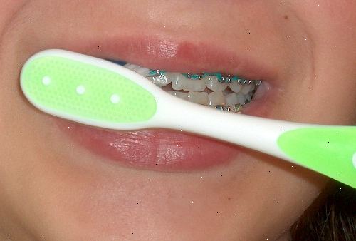 Hoe kunt u uw tanden te poetsen met beugels aan. Krijg een reiniging met uw mondhygiënist.