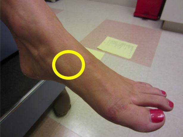 Hoe maak je een voet stressfractuur behandelen. Herken de symptomen van een stressfractuur in de voet.