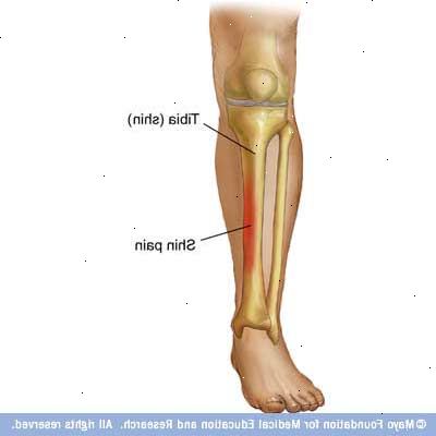 Hoe te shin splints te voorkomen. Weet dat shin splints kan worden veroorzaakt door verschillende factoren.