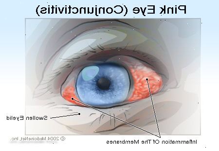 Hoe om te gaan met roze oog. Evalueer de ernst van uw aandoening.